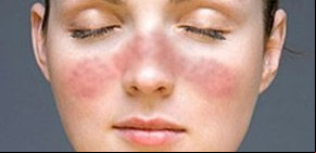Lupus: una enfermedad que duele más allá del cuerpo