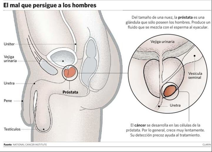 Cáncer de próstata, el mal que persigue a los hombres.