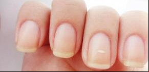 Por qué aparecen esas "odiosas" manchitas blancas en las uñas