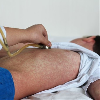 Brote de sarampión: síntomas, cómo se contagia y previene