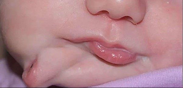 Una bebita nació con dos bocas: cómo lograron curarla los médicos luego de seis meses