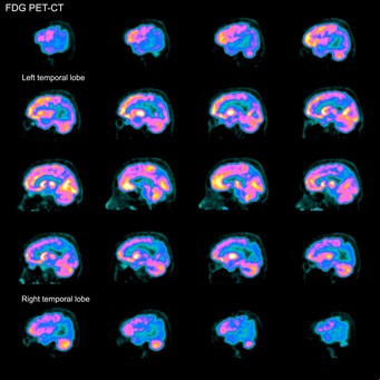 Logran que una prueba de sangre diagnostique con precisión el Alzheimer