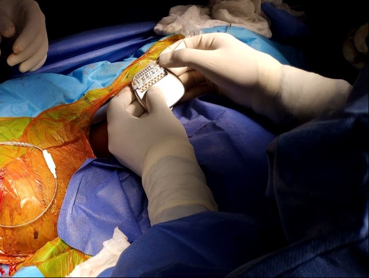 En primer plano, la colocación del neuroestimulador. "La intervención puede ser curativa o paliativa, generando en la mayoría de los casos un gran impacto positivo en la calidad de vida de los pacientes", explican los médicos.