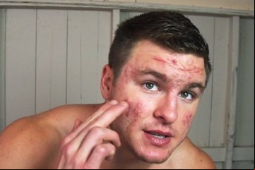 "Se burlaban de mí y me sentía solo", la impactante transformación de un chico con un severo acné