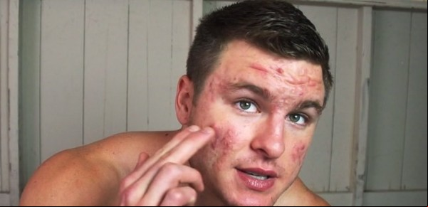 "Se burlaban de mí y me sentía solo", la impactante transformación de un chico con un severo acné