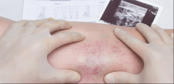 Trombosis venosa y arterial: las diferencias y 10 consejos que no sabías para evitar la formación de coágulos