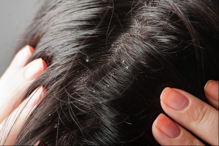 Sus propiedades antifúngicas y antibacterianas contribuirían a combatir la caspa. Foto: Shutterstock.