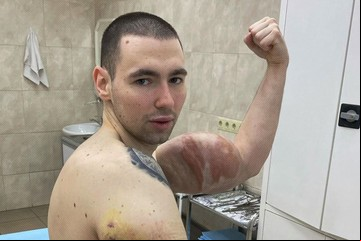 El "Popeye ruso" fue operado nuevamente para extraer la mezcla casera que se inyectó en sus bíceps