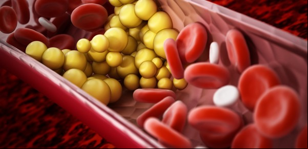 Un nuevo tratamiento contra el colesterol logró ser más eficaz que otros métodos