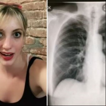 Fue al médico por una tos molesta y descubren que tiene el corazón del otro lado del pecho
