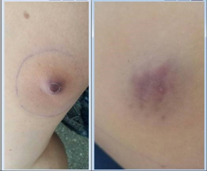 Los abscesos en enero: Daniela llegó a tener 29.