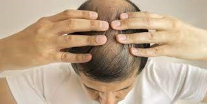 Las causas de la caída del cabello o alopecía son multifactoriales.