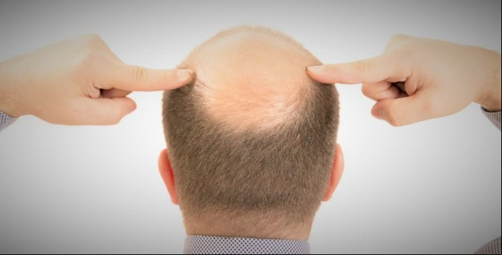 Existen distintos tipos de alopesia.