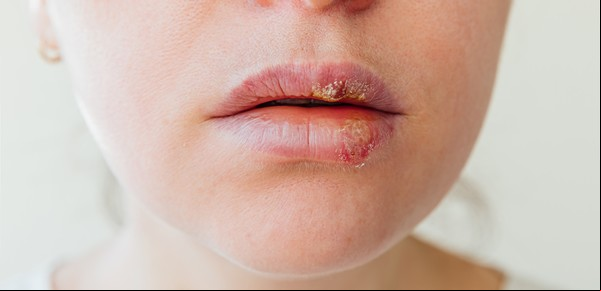 Cómo combatir el herpes labial: consejos y tratamientos efectivos
