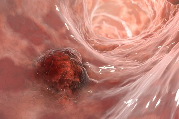 Cáncer de colon: la estatura puede influir en el riesgo, advierte un estudio