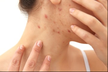 Cómo hacer una máscara facial casera para el acné