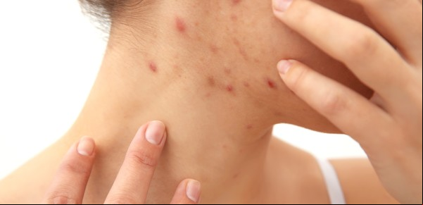 Cómo hacer una máscara facial casera para el acné