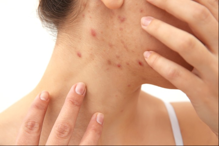 El acné es más frecuente entre los 13 y los 17 años. Foto Shutterstock.