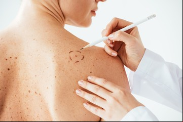 ¿Lunar o melanoma? Claves para diferenciarlos