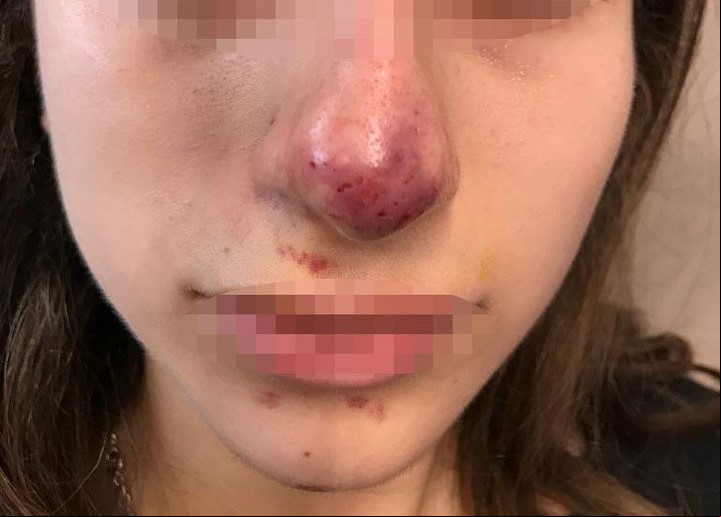 Complicación vascular: colocaron ácido hialurónico dentro de una arteria del rostro y se ocluyo, por lo que no llegó sangre ni oxígeno a la punta nasal.