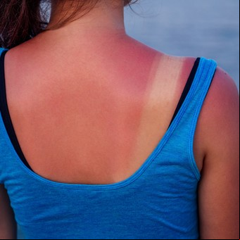 Cuánto tiempo tomar sol y en qué horarios para broncearse con el menor daño para la piel