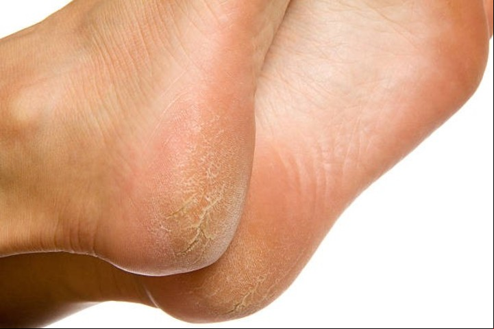 Callos en los pies. Foto: Getty Images