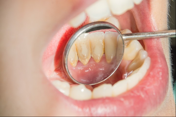 El sarro es la calcificación de la placa bacteriana, o placa dental. Foto: Shutterstock