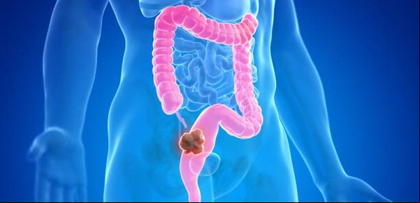¿Cómo prevenir el cáncer de colon según la Universidad de Harvard?
