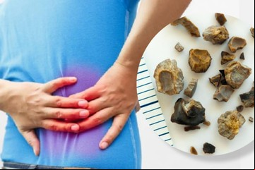 El alimento que aumenta el riesgo de desarrollar cálculos renales, según un nuevo estudio