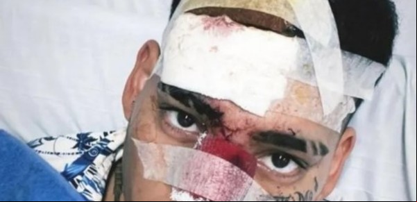 El cantante urbano Kaleb Di Masi chocó contra un patrullero y se salvó de milagro: "Tengo 40 puntos en la cara y la nariz partida"