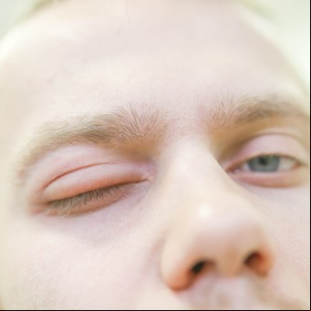 Angioedema hereditario: cómo saber cuándo la hinchazón no es solo una alergia