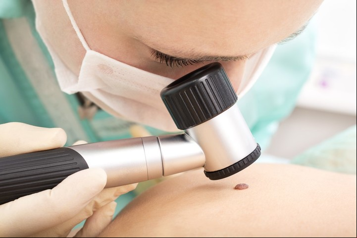 Ante el cambio de aspecto de cualquier tipo de lunar es esencial hacer un chequeo con un médico dermatólogo.