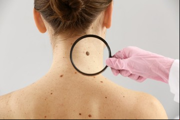La vitamina que reduce el riesgo de padecer melanoma en la piel