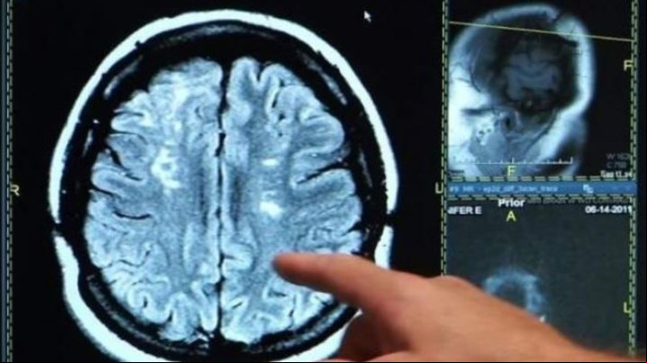 Resonancia magnética cerebro.