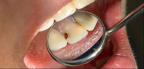 Sin anestesia ni torno: un argentino creó una forma de remover las caries sin dolor