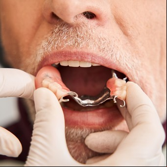 Pérdida de dientes, encías bajas, bruxismo: los problemas más comunes en la boca después de los 60 y cómo prevenirlos
