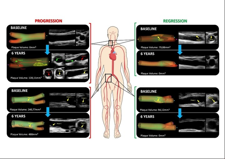 Casos de progresión de aterosclerosis (izquierda) y de regresión (desaparición de la misma, derecha) en arterias carótidas (en el cuello) en las femorales. Imagen gentileza CNIC.