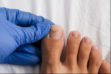 Hongos en pies y manos: por qué en las uñas son difíciles de tratar y los errores más comunes