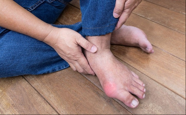 Los niveles elevados de ácido úrico puede generar inflamación de las articulaciones, en especial  en el dedo gordo del pie.