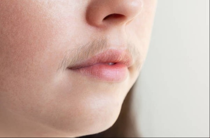 El exceso de vello en zonas no habituales puede indicar enfermedades. Foto: iStock.