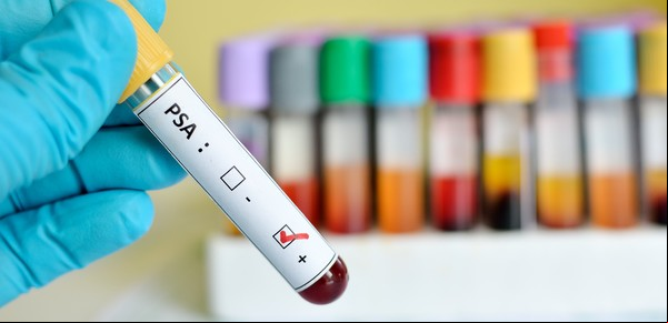 Cuáles son las enfermedades más graves que pueden detectarse con un simple análisis de sangre