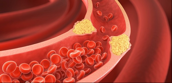 Hipercolesterolemia familiar, un enemigo silencioso que aumenta el riesgo de infartos prematuros