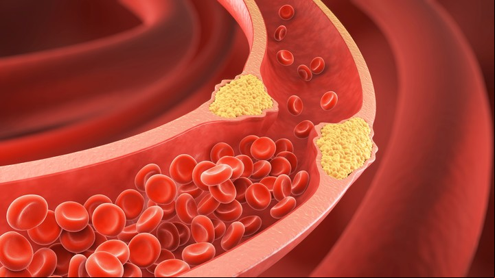 El zapote negro ayuda a la salud de la corazón reduciendo los niveles del colesterol LDL. Foto Shutterstock.
