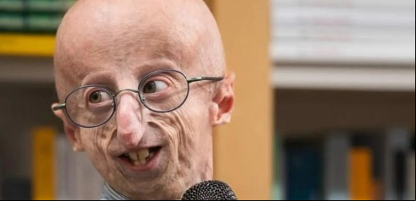 Murió Sammy Basso: qué es la progeria, la extraña enfermedad que padecía