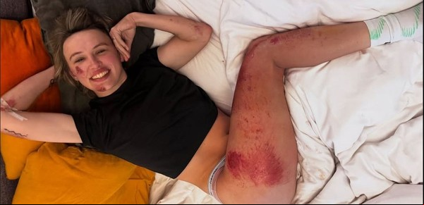 Una ciclista mostró sus brutales heridas tras una estremecedora caída en una carrera en Italia: "Siempre podría ser peor..."