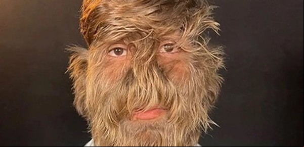 Es muy feliz así: el adolescente que tiene el síndrome del hombre lobo