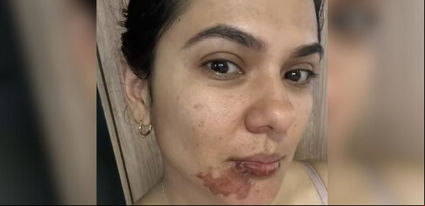 Sufrió un imprevisto con una empanada y su historia llegó a millones: "Explotó en mi cara"