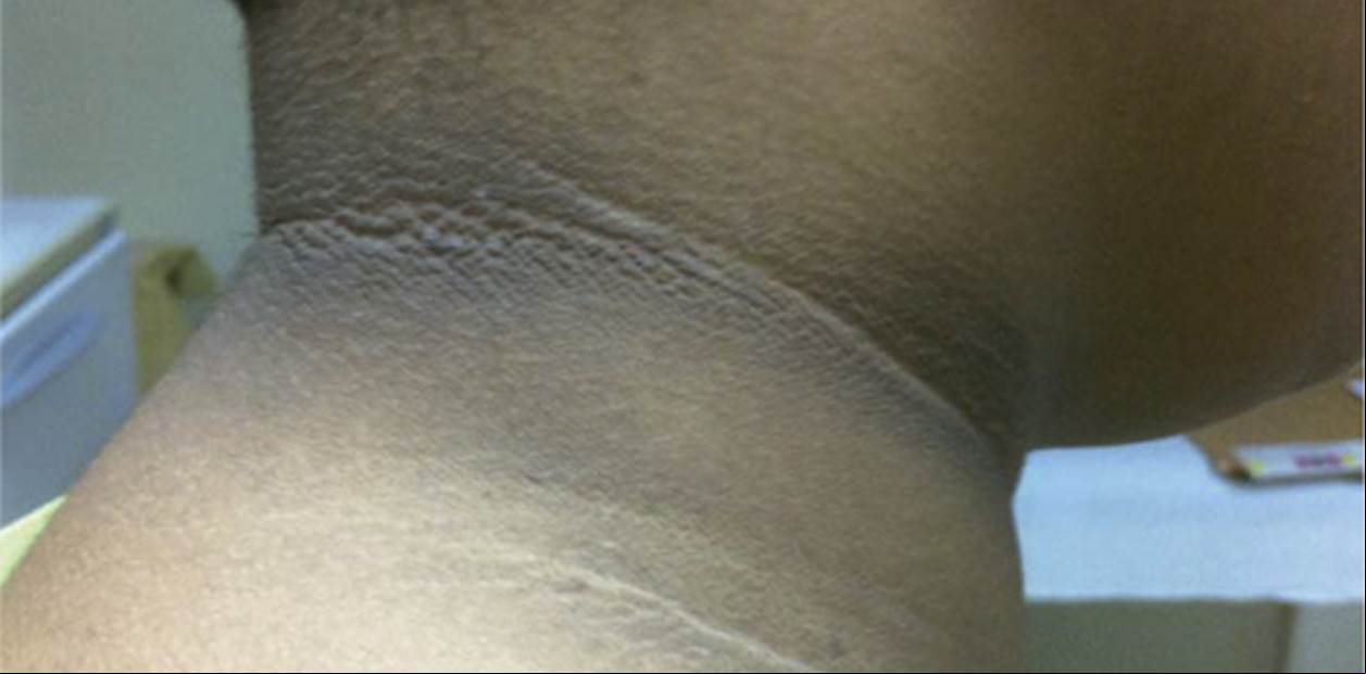 Cuello oscuro: qué significa y cuándo puede ser una señal de alerta