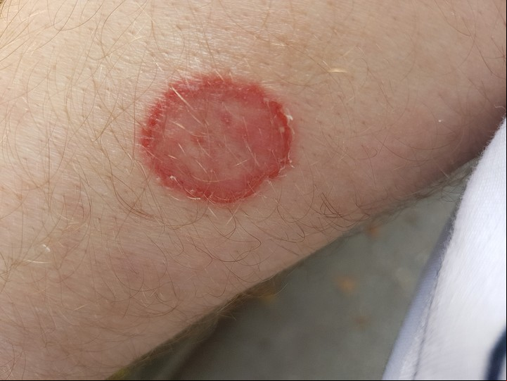 Un caso de tiña corporal, también conocida como tinea corporis. Foto ilustrativa: Asurnipal, CC BY-SA 4.0 (https://creativecommons.org/licenses/by-sa/4.0), via Wikimedia Commons.