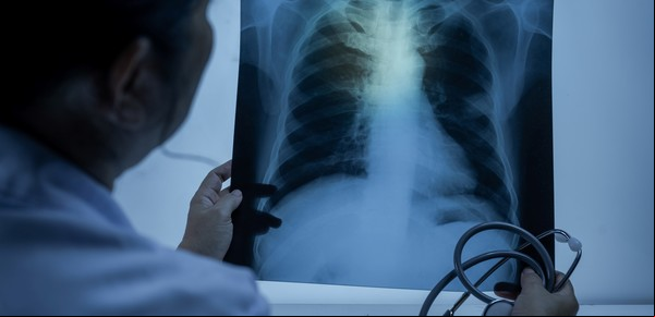 Neumonía bilateral: qué es y cómo reducir el riesgo de sufrir el cuadro que afectó al Papa y a Gatti